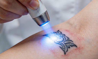 Laser Tattoo Removal Machine Manufacturer for Professional Clinics in Europe and the US Laser Tattoo Removal Machine Manufacturer for Professional Clinics in Europe and the US
